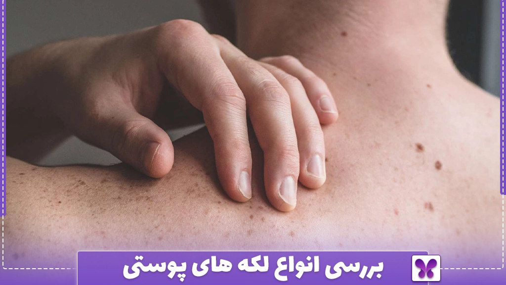 بررسی انواع لکه های پوستی