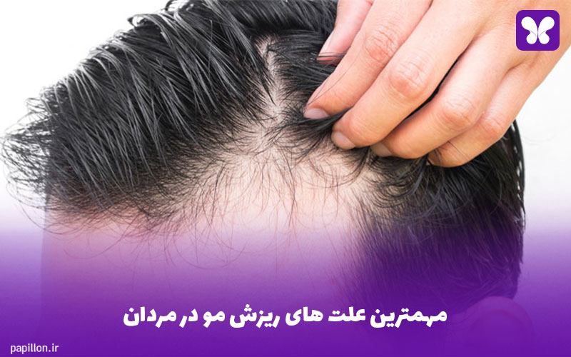 مهمترین علت های ریزش مو در مردان