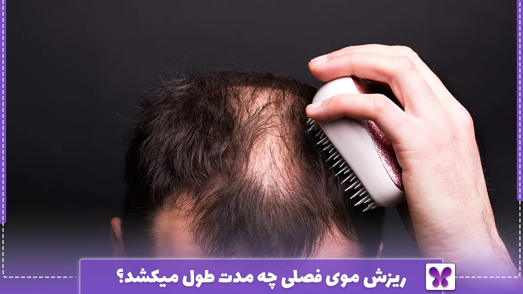 ریزش موی فصلی چه مدت طول میکشد؟