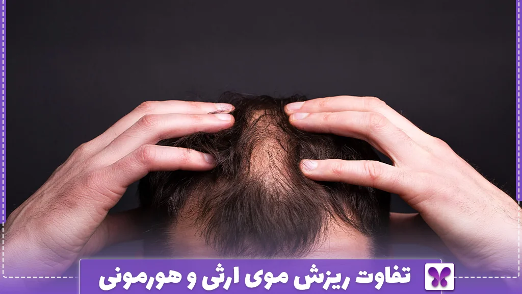 تفاوت ریزش موی ارثی و هورمونی