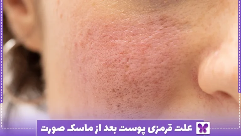 علت قرمزی پوست بعد از ماسک صورت