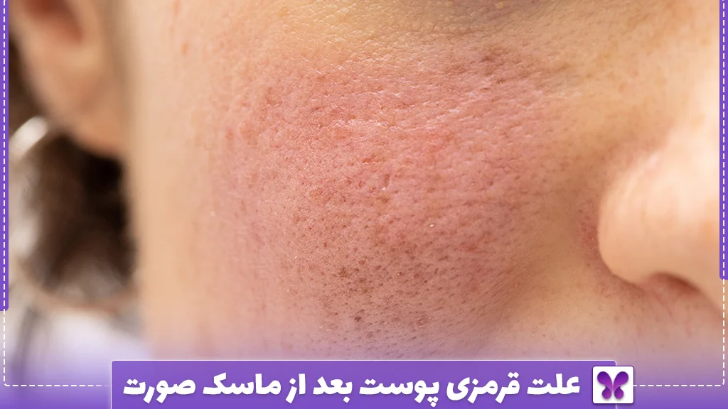 علت قرمزی پوست بعد از ماسک صورت