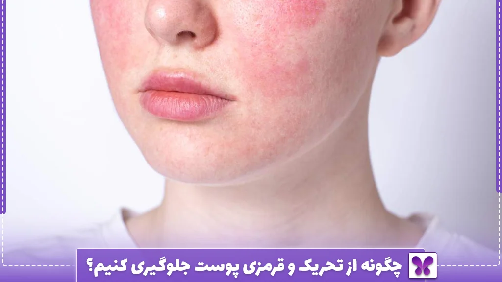 چگونه از تحریک و قرمزی پوست جلوگیری کنیم؟
