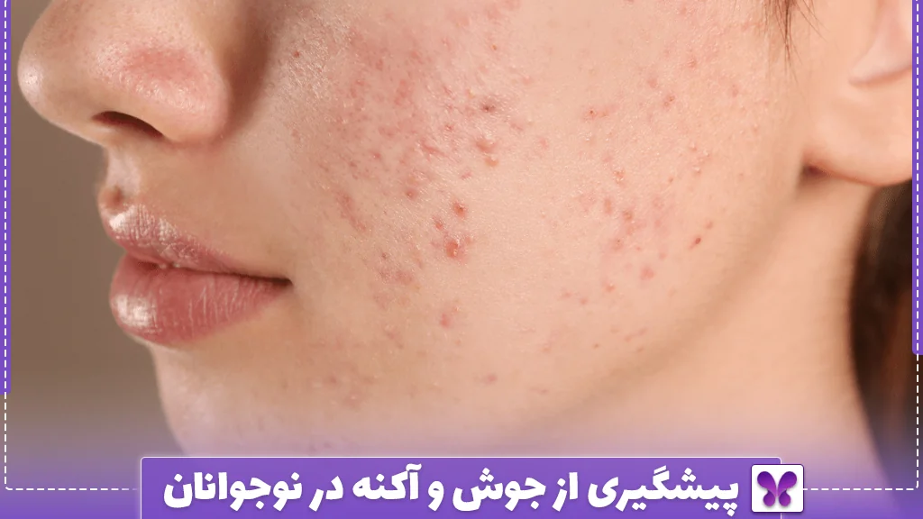 پیشگیری از جوش و آکنه در نوجوانان