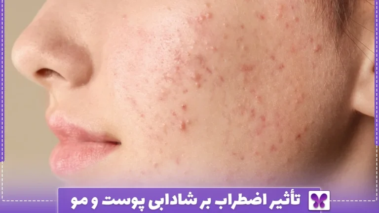 تأثیر اضطراب بر شادابی پوست و مو