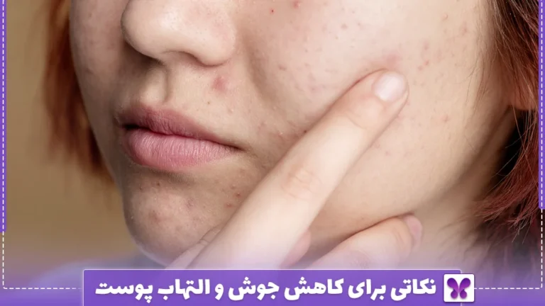 نکاتی برای کاهش جوش و التهاب پوست
