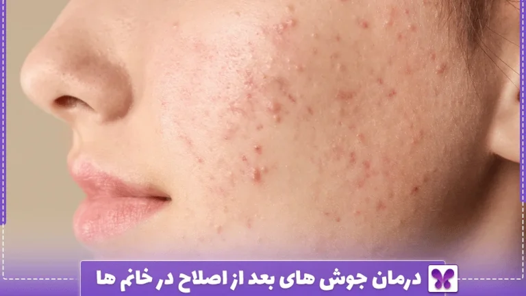 درمان جوش های بعد از اصلاح در خانم ها