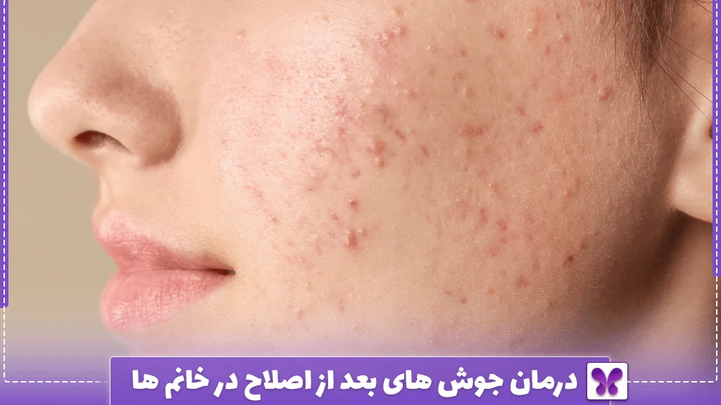 درمان جوش های بعد از اصلاح در خانم ها