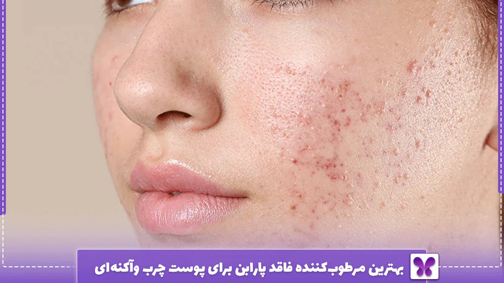 بهترین مرطوبکننده فاقد پارابن برای پوست چرب وآکنهای