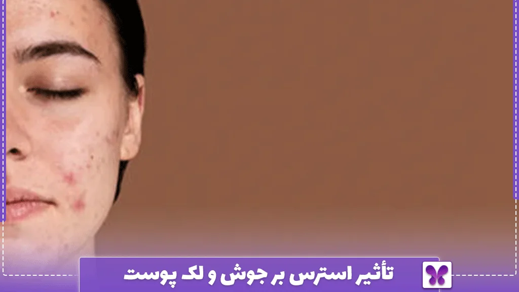 تأثیر استرس بر جوش و لک پوست