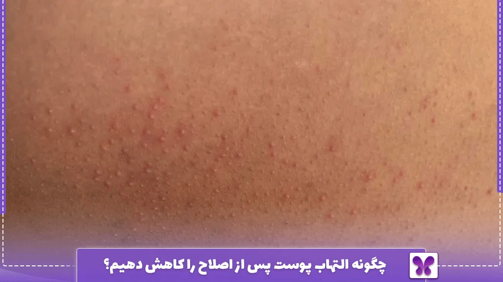 چگونه التهاب پوست پس از اصلاح را کاهش دهیم؟